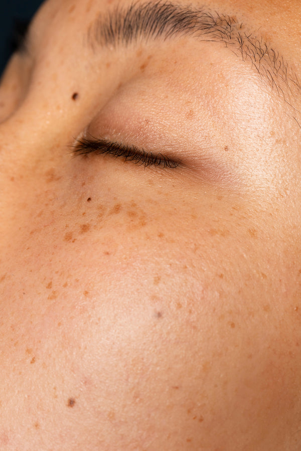 Hyperpigmentation